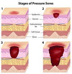 Homecare: the Basics of Bedsores and How to Deal with them