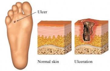 Proactive Wintertime Tips for Diabetic Foot Care